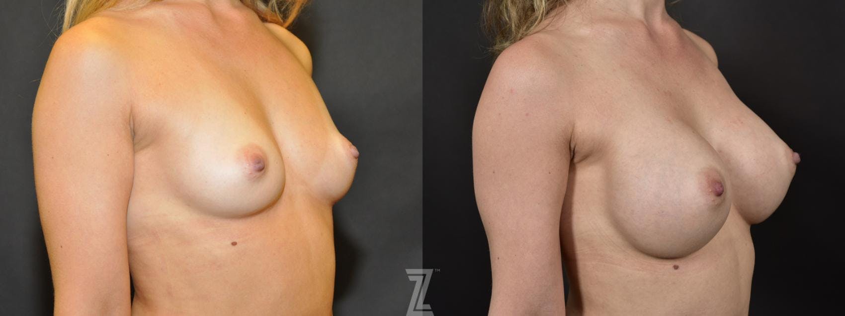 Breast Augmentation Before & After Gallery - Patient 132791044 - Image 4
