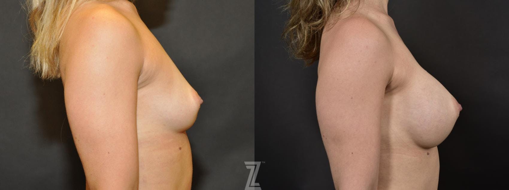 Breast Augmentation Before & After Gallery - Patient 132791044 - Image 5
