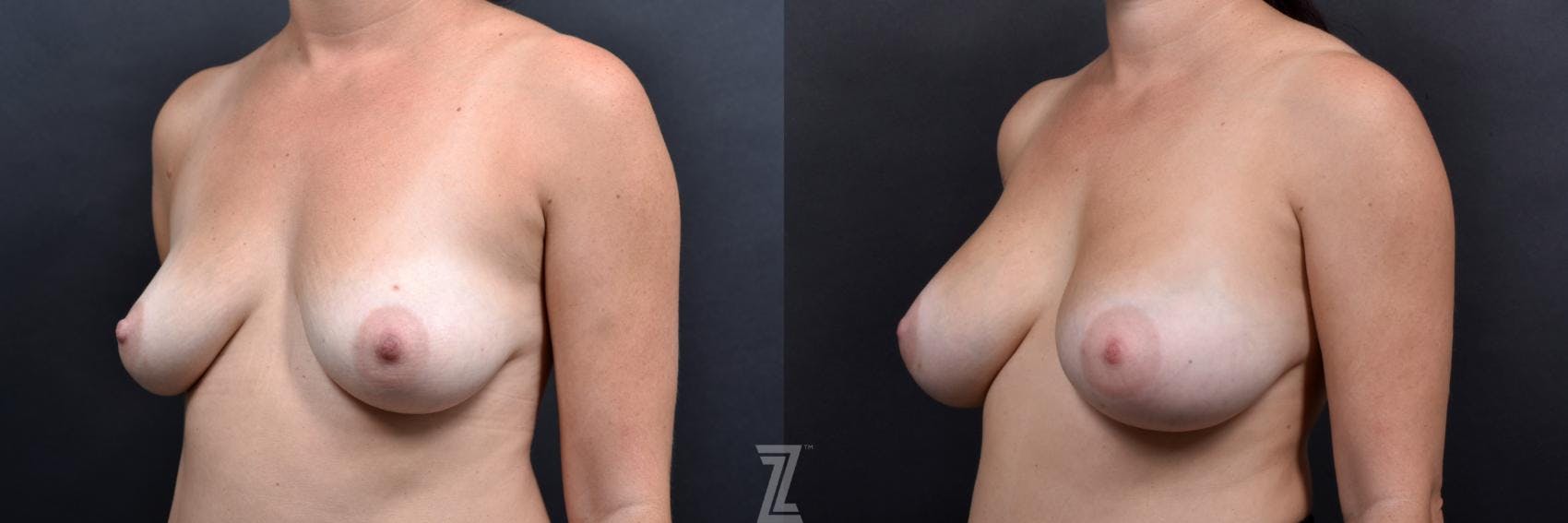 Breast Augmentation Before & After Gallery - Patient 132791046 - Image 2