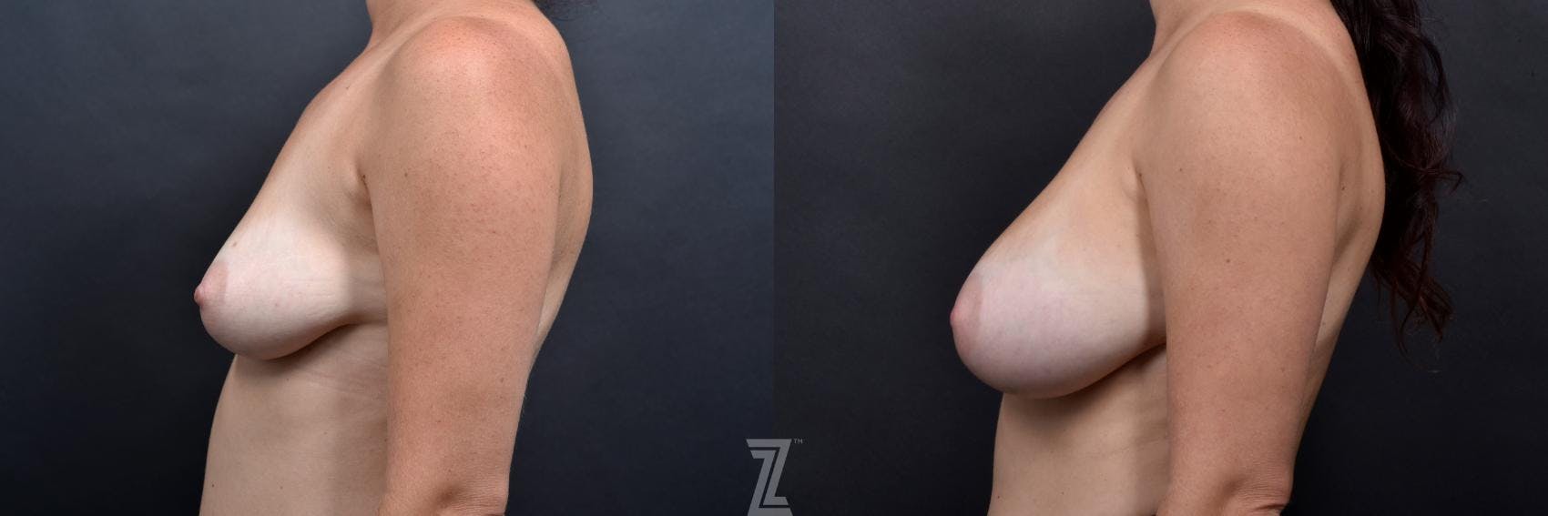 Breast Augmentation Before & After Gallery - Patient 132791046 - Image 3