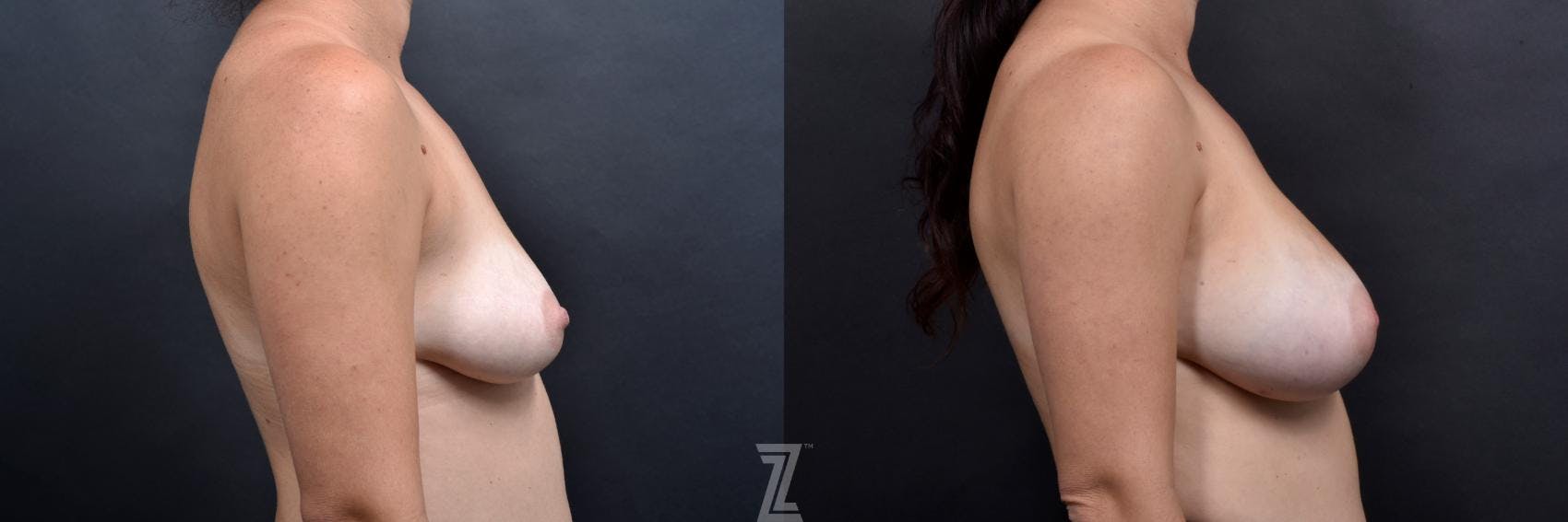 Breast Augmentation Before & After Gallery - Patient 132791046 - Image 5