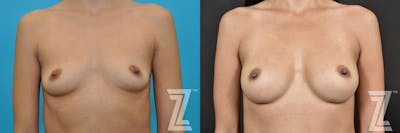 Austin Bilateral View Before & After Breast Augmentation  of 32-Year-Old Female Patient With  Silicone Implants with Cohesive Silicone Gel - The Piazza Center