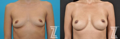 Breast Augmentation Before & After Gallery - Patient 132791055 - Image 1