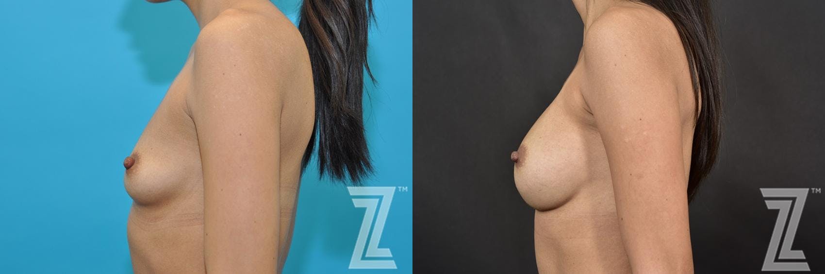 Breast Augmentation Before & After Gallery - Patient 132791055 - Image 3