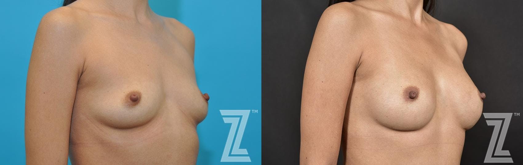 Breast Augmentation Before & After Gallery - Patient 132791055 - Image 4