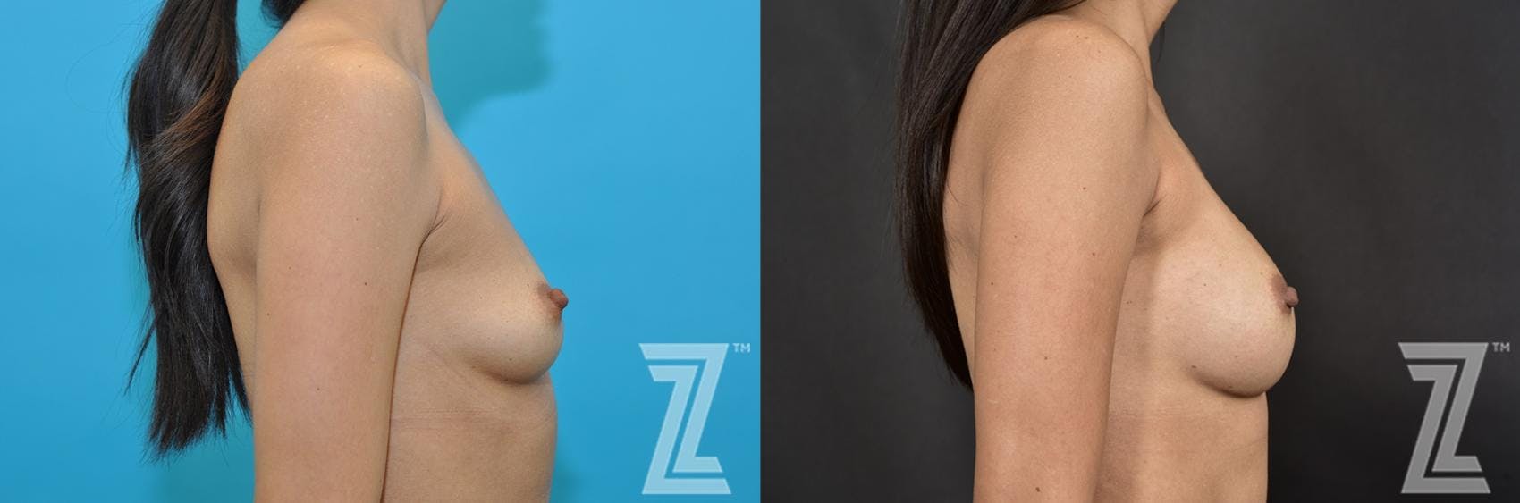 Breast Augmentation Before & After Gallery - Patient 132791055 - Image 5