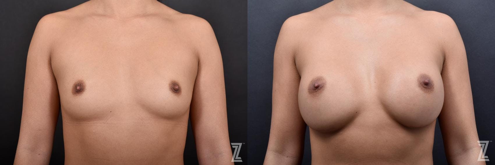 Breast Augmentation Before & After Gallery - Patient 132791057 - Image 1
