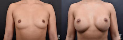 Austin Before & After Breast Augmentation  of 25-Year-Old Female Patient at The Piazza Center in Austin - Dr. Piazza - The Piazza Center