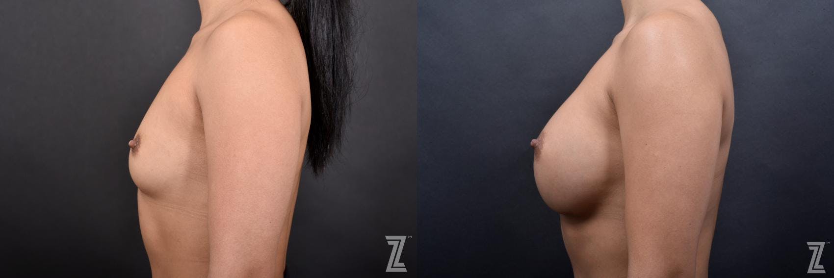 Breast Augmentation Before & After Gallery - Patient 132791057 - Image 3