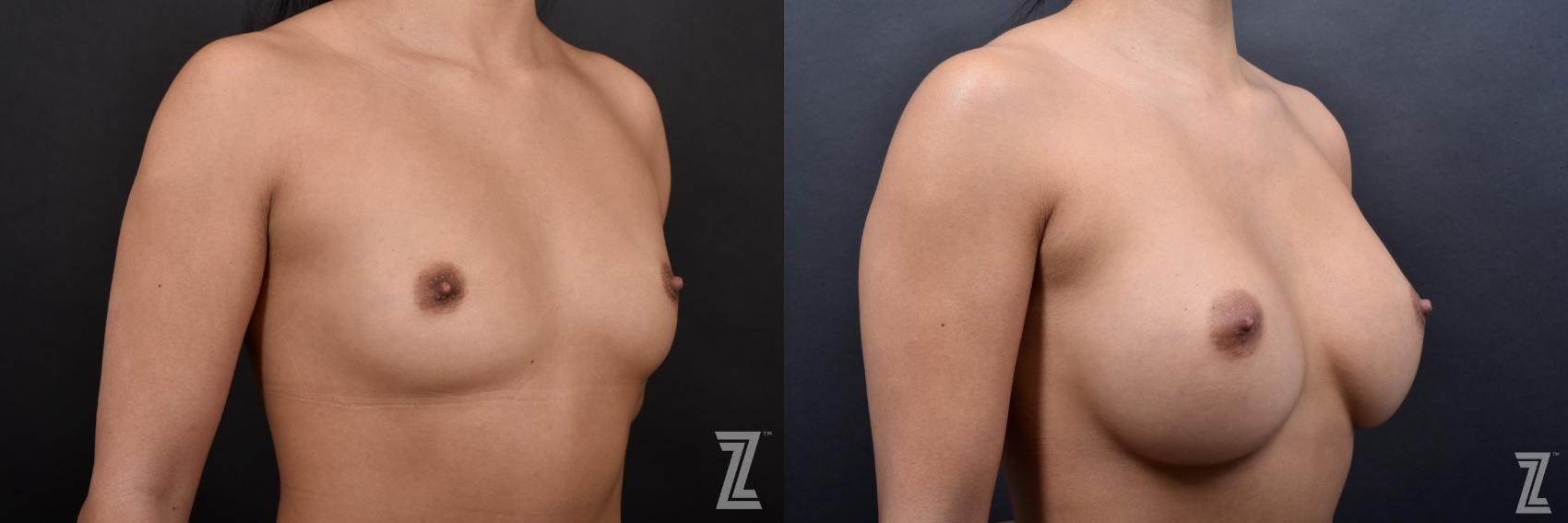 Breast Augmentation Before & After Gallery - Patient 132791057 - Image 4