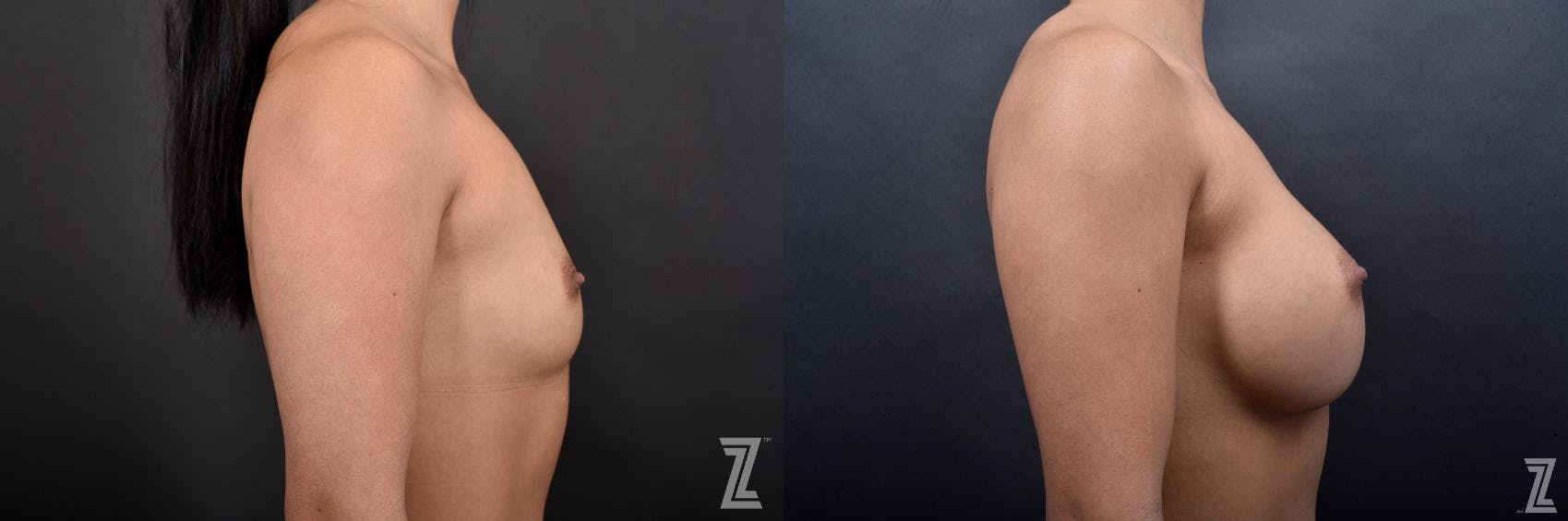 Breast Augmentation Before & After Gallery - Patient 132791057 - Image 5