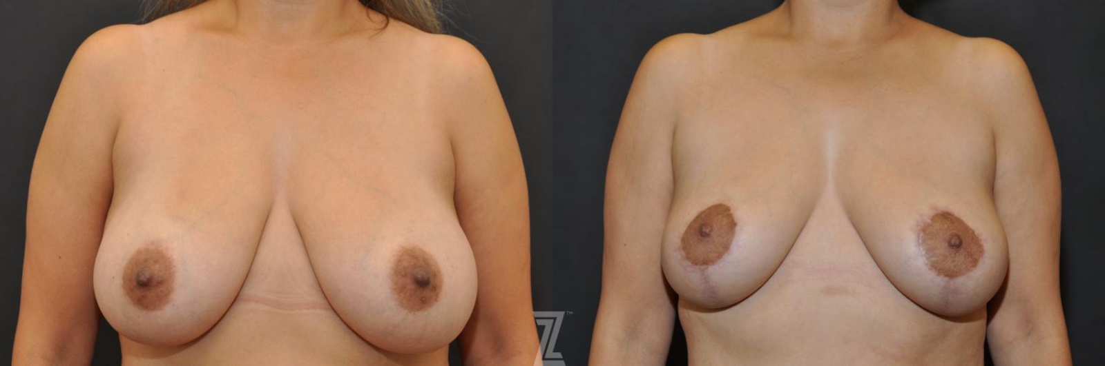 Austin Breast Lift Before & After Gallery - Patient 132791061 - Image 1 - The Piazza Center