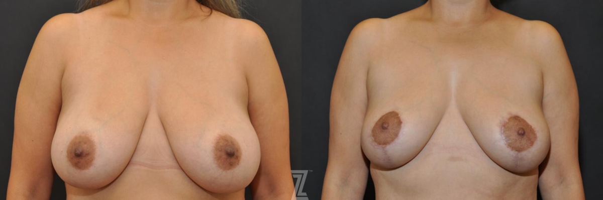 Austin Breast Lift Before & After Gallery - Patient 132791061 - Image 1 - The Piazza Center