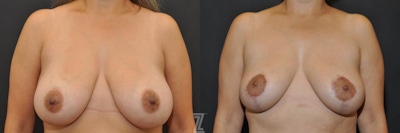 Breast Lift Before & After Gallery - Patient 132791061 - Image 1