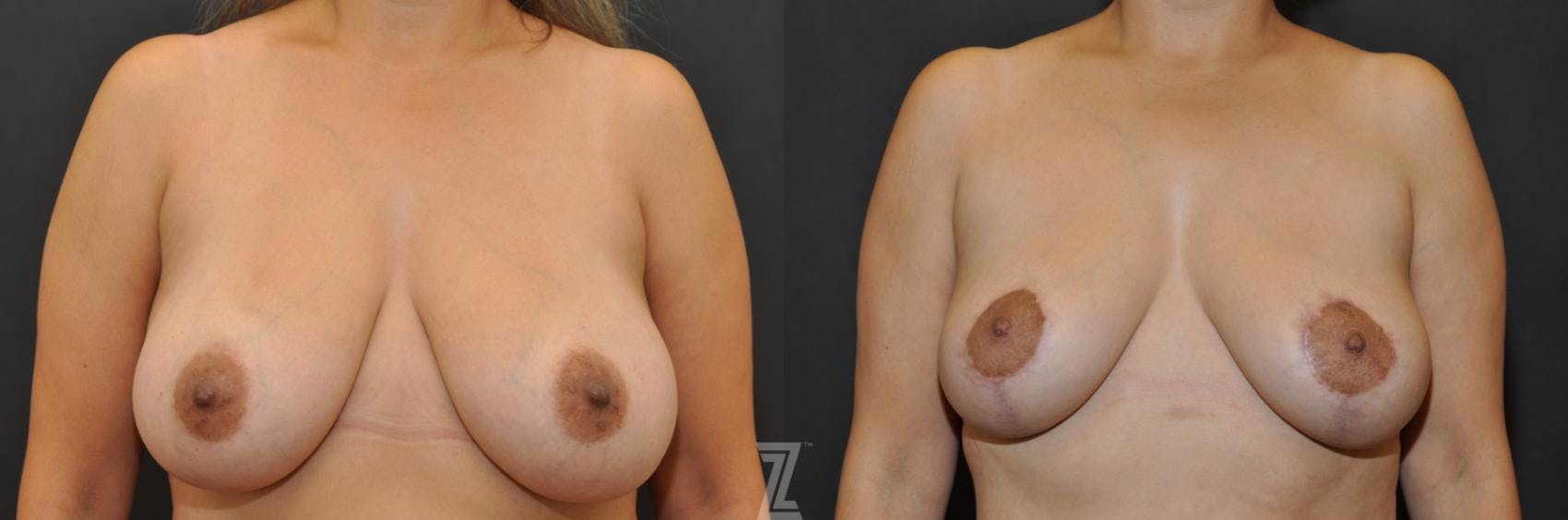 Breast Lift Before & After Gallery - Patient 132791061 - Image 1