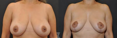 Austin Breast Lift Before & After Gallery - Patient 132791061 - Image 1 - The Piazza Center