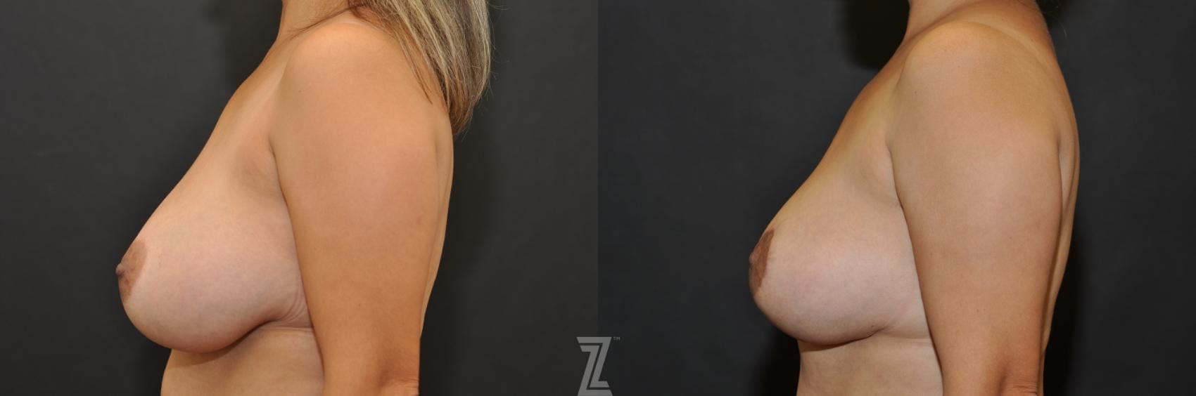 Breast Lift Before & After Gallery - Patient 132791061 - Image 3