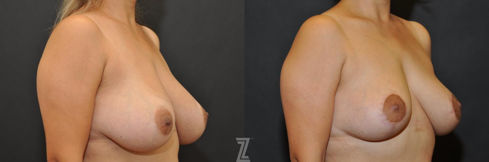 Breast Lift Before & After Gallery - Patient 132791061 - Image 4
