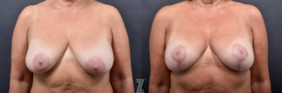 Austin Breast Lift Before & After Gallery - Patient 132791067 - Image 1 - The Piazza Center