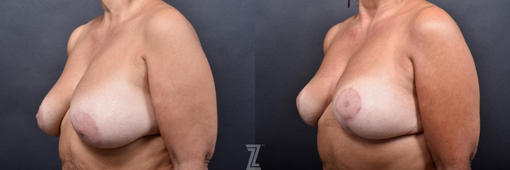 Breast Lift Before & After Gallery - Patient 132791067 - Image 2