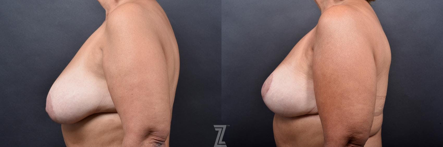 Breast Lift Before & After Gallery - Patient 132791067 - Image 3
