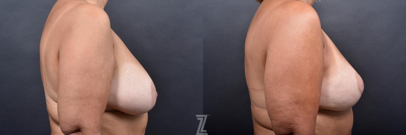 Breast Lift Before & After Gallery - Patient 132791067 - Image 5