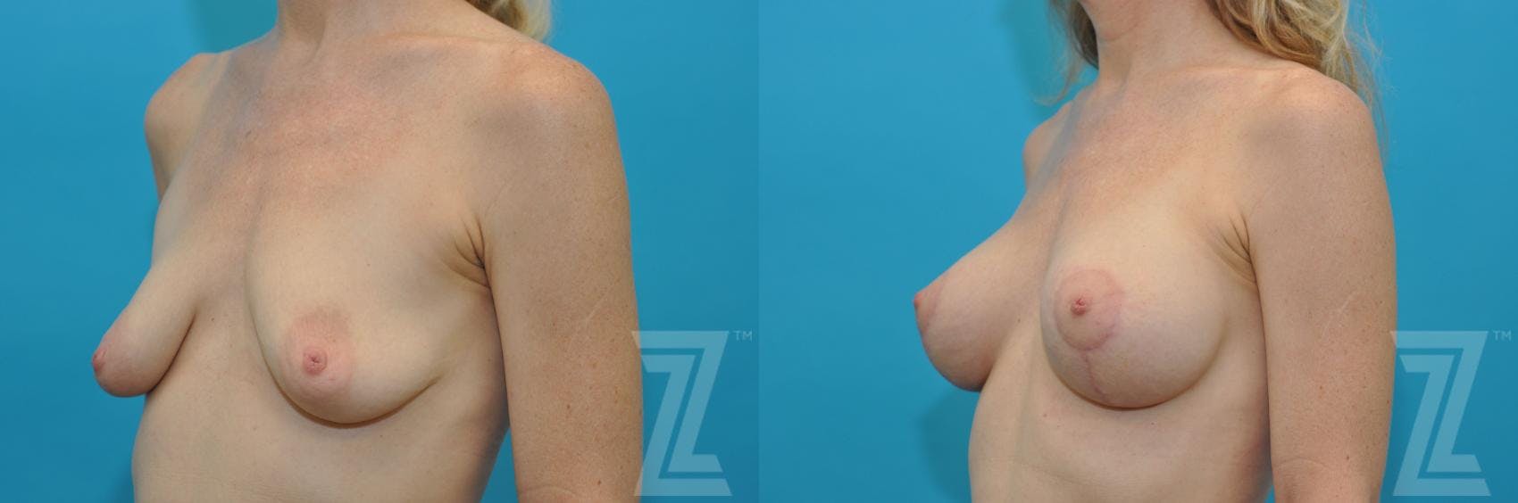 Breast Lift Before & After Gallery - Patient 132791069 - Image 2