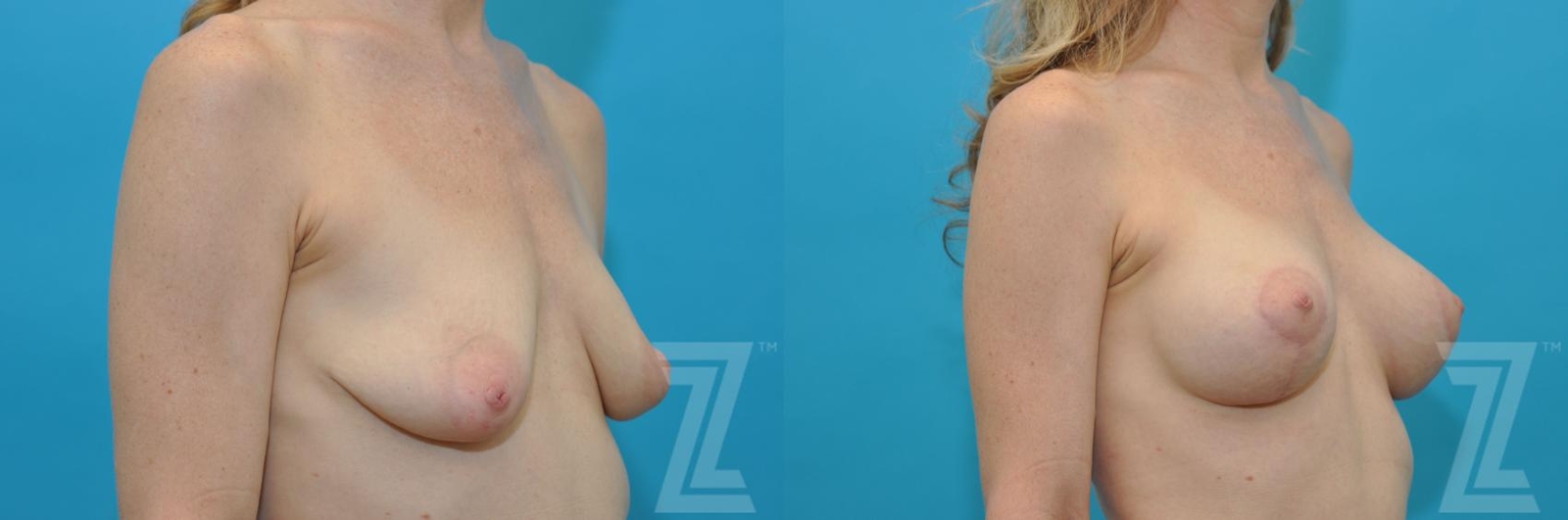 Austin Breast Lift Before & After Gallery - Patient 132791069 - Image 4 - The Piazza Center