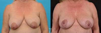Austin Breast Lift Before & After Gallery - Patient 132791071 - Image 1 - The Piazza Center