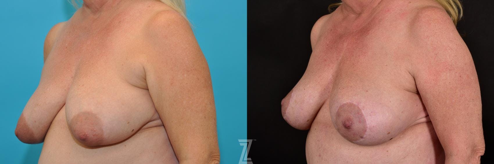 Breast Lift Before & After Gallery - Patient 132791071 - Image 2