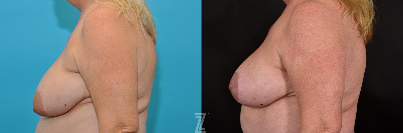 Breast Lift Before & After Gallery - Patient 132791071 - Image 3