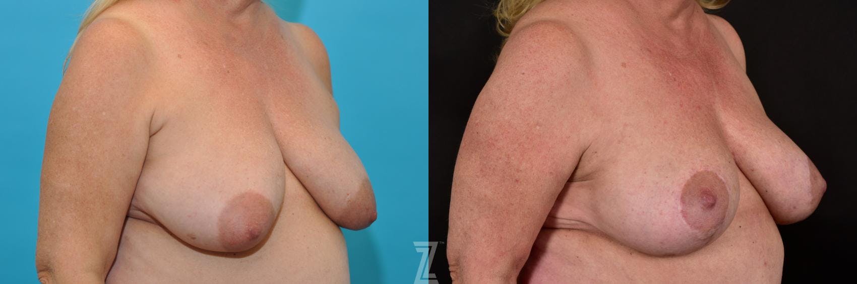 Breast Lift Before & After Gallery - Patient 132791071 - Image 4
