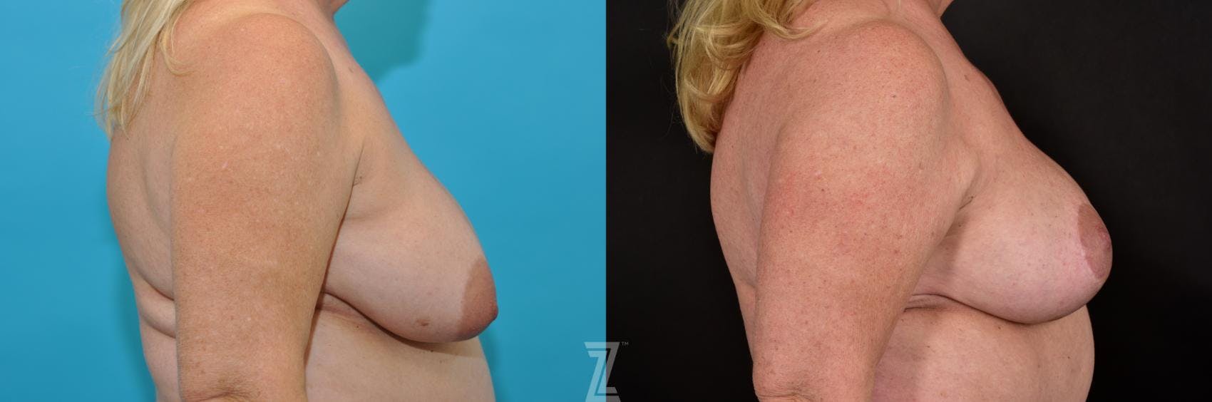 Breast Lift Before & After Gallery - Patient 132791071 - Image 5