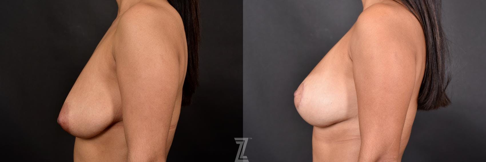 Breast Lift Before & After Gallery - Patient 132791072 - Image 3