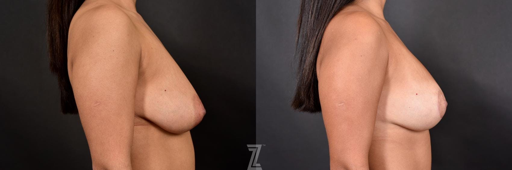Breast Lift Before & After Gallery - Patient 132791072 - Image 5