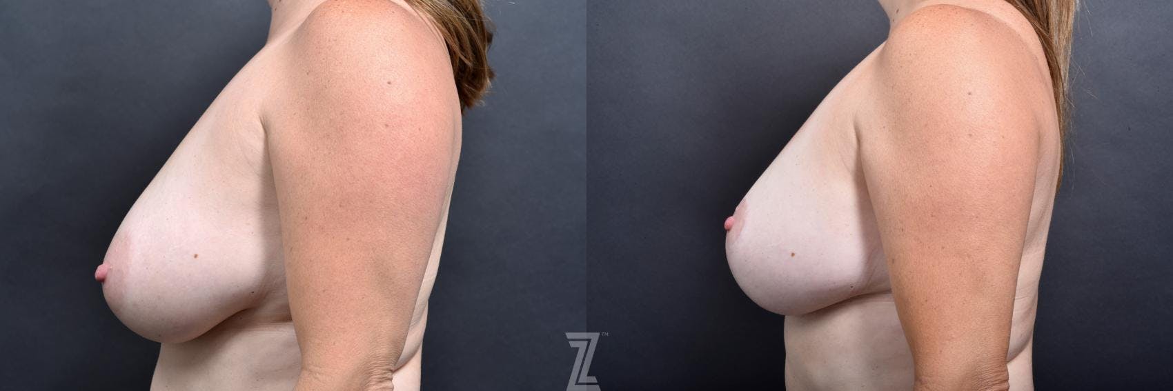 Breast Lift Before & After Gallery - Patient 132791077 - Image 3