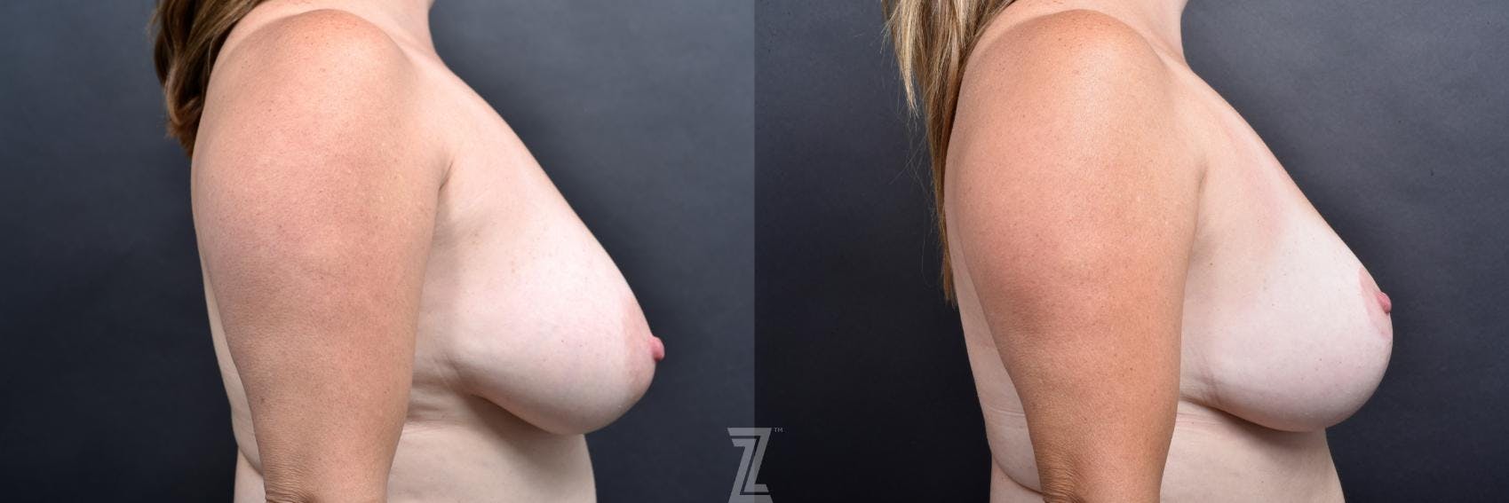 Breast Lift Before & After Gallery - Patient 132791077 - Image 5