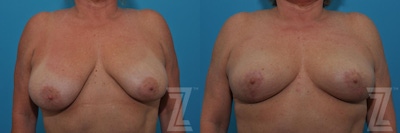 Breast Lift Before & After Gallery - Patient 132791080 - Image 1