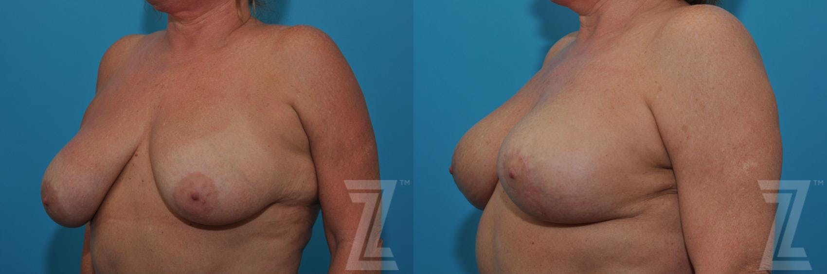 Breast Lift Before & After Gallery - Patient 132791080 - Image 2