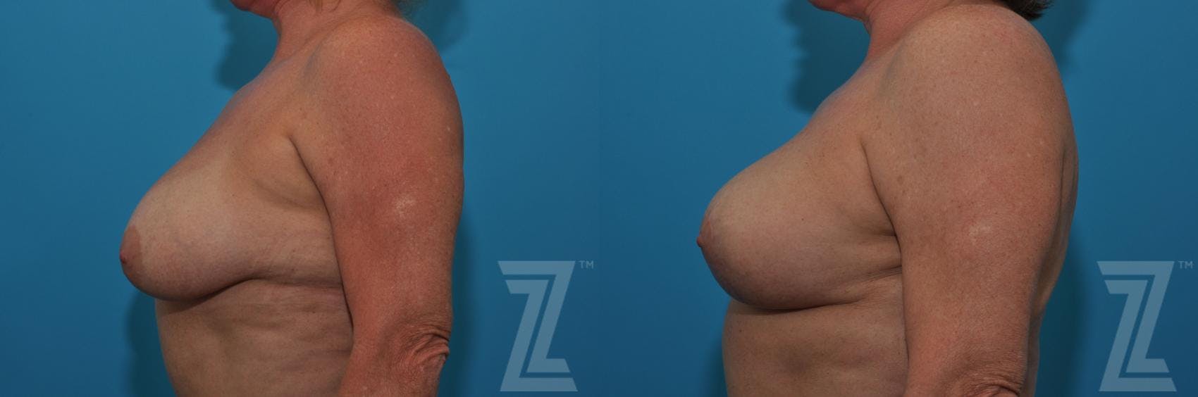 Breast Lift Before & After Gallery - Patient 132791080 - Image 3