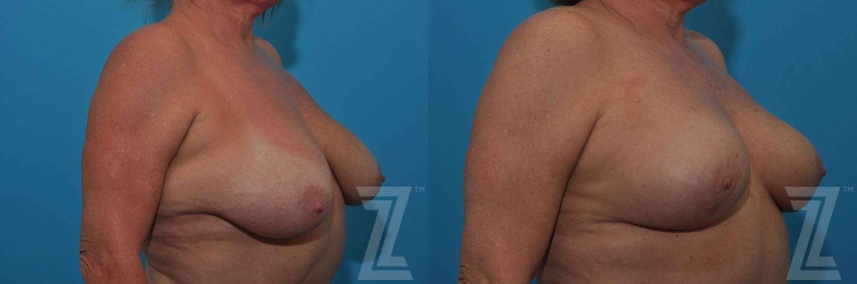 Breast Lift Before & After Gallery - Patient 132791080 - Image 4