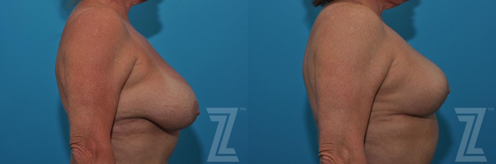 Breast Lift Before & After Gallery - Patient 132791080 - Image 5