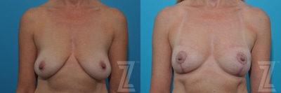Breast Lift Before & After Gallery - Patient 132791081 - Image 1