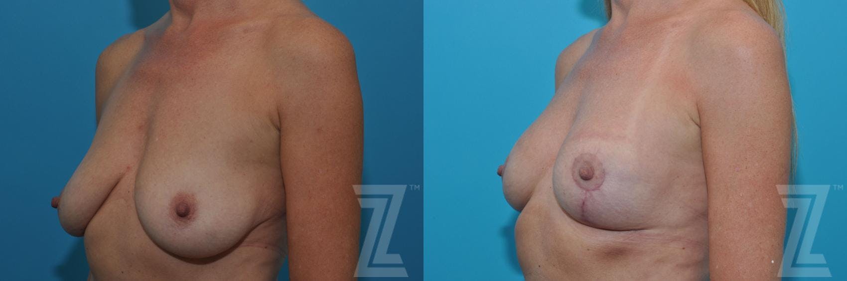 Breast Lift Before & After Gallery - Patient 132791081 - Image 2