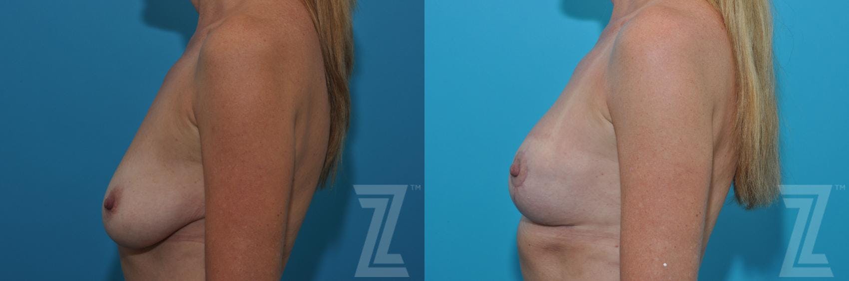 Breast Lift Before & After Gallery - Patient 132791081 - Image 3