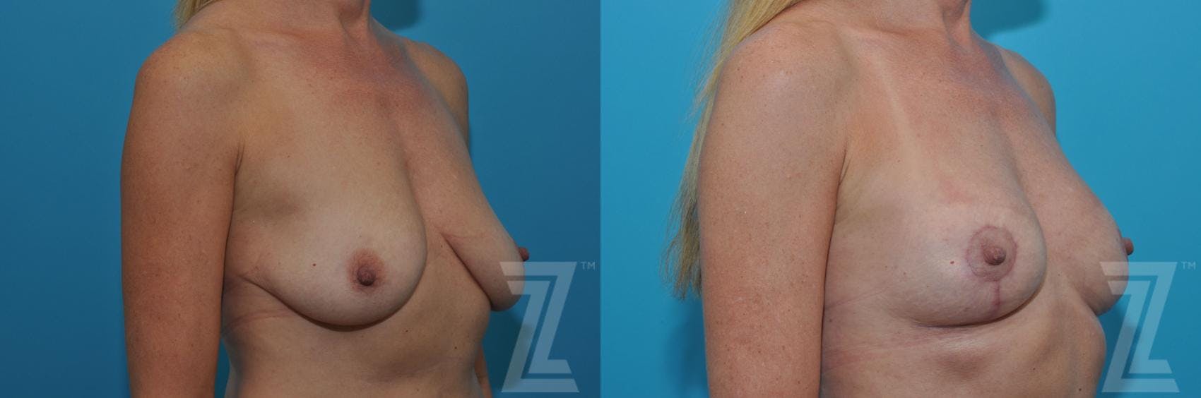 Breast Lift Before & After Gallery - Patient 132791081 - Image 4