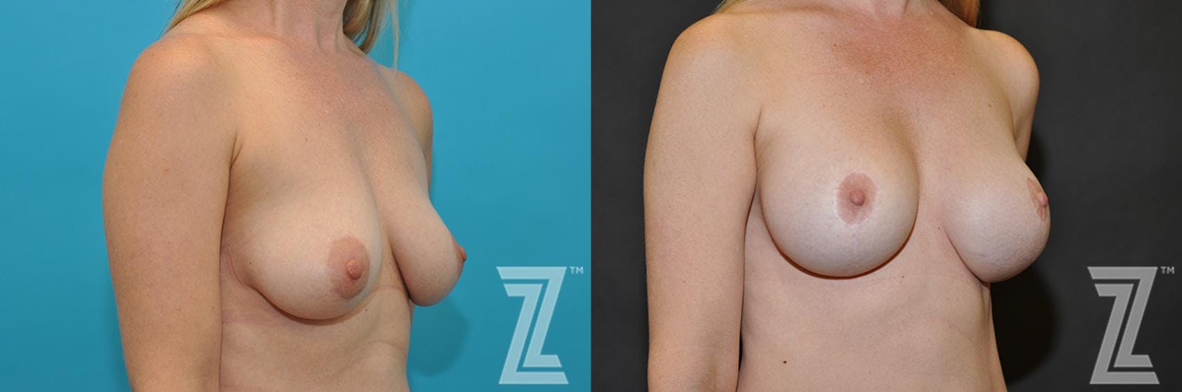 Breast Augmentation With a Breast Lift Before & After Gallery - Patient 132791083 - Image 3