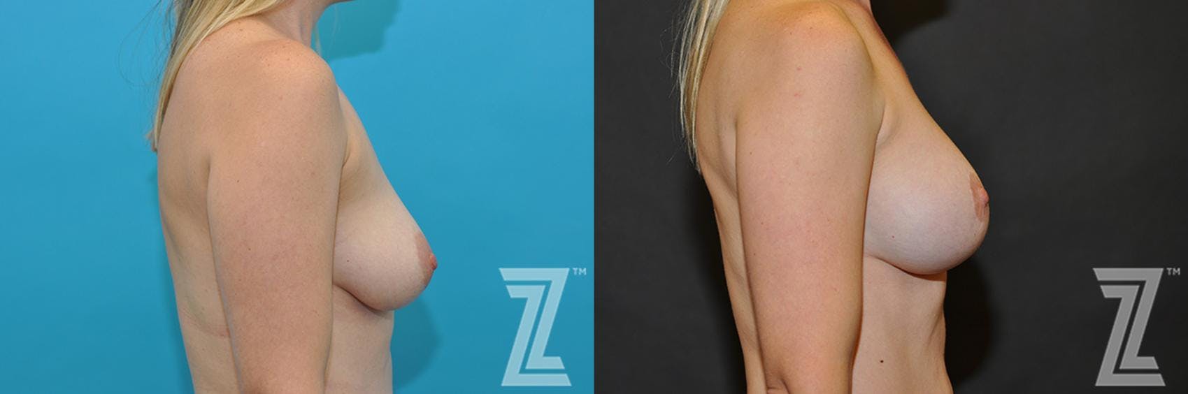 Breast Augmentation With a Breast Lift Before & After Gallery - Patient 132791083 - Image 4