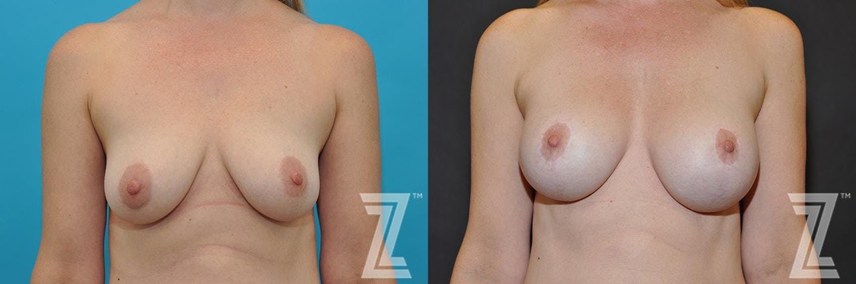 Breast Augmentation With a Breast Lift Before & After Gallery - Patient 132791083 - Image 5