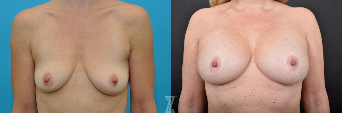 Austin Breast Augmentation With a Breast Lift Before & After Gallery - Patient 132791085 - Image 1 - The Piazza Center